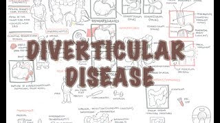 Diverticular Disease diverticulitis  Overview [upl. by Fishback]