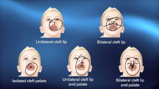 Cleft Lip and Cleft Palate For Students [upl. by Gerta387]