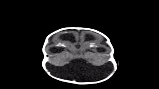 How Genetic Defects Cause Microcephaly [upl. by Oleg794]