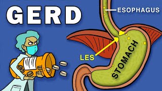 Gastroesophageal Reflux Disease GERD [upl. by Nesnej]