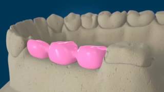 Prótese fixa de 3 elementos cimentada sobre implantes dentários [upl. by Acireh]