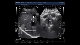 Ultrasound Video showing a hemangioma and two Hydatid cysts in liver [upl. by Enaffit]