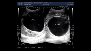 Ultrasound Video showing a large Renal Cyst [upl. by Nylrehc]