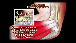 How is cubital tunnel syndrome diagnosed [upl. by Jeralee256]