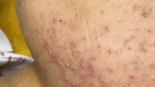 Blackheads And Pimples  Mụn Đầu Đen  SacDepSpa320 [upl. by Richy503]