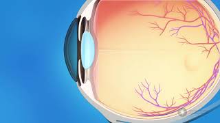 What is glaucoma [upl. by Lesley]