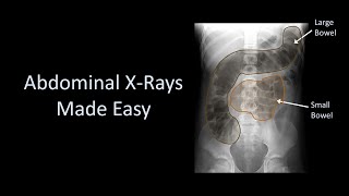 Abdominal XRays Made Easy [upl. by Aztinaj]