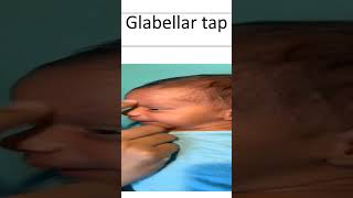 Glabellar Tap [upl. by Newmark638]