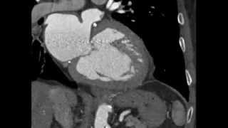 Atrial Septal Aneurysm ASA [upl. by Einniw972]