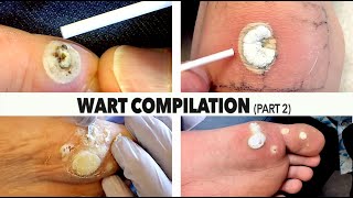 WART BURNING COMPILATION Part 2  Dr Paul [upl. by Ailecra]