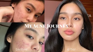 How I Cleared my Acne somehow PHILIPPINES  Lj Torres [upl. by Myrtice]