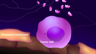 Hypercalcemia in malignancy  causes pathophysiology symptoms treatment [upl. by Nibot]