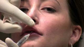 Juvederm Ultra filler injection to lips for lip augmentation in Virginia [upl. by Gemperle]