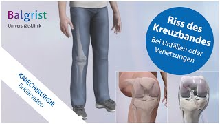 Kreuzbandriss operative Behandlung vordere Kreuzbandruptur [upl. by Pittman]