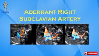 Aberrant Right Subclavian Artery [upl. by Lurleen]