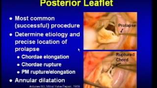 Aortic Stenosis  Overview signs and symptoms pathophysiology treatment [upl. by Oiciruam]