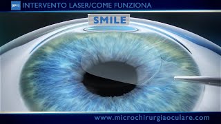 Intervento Laser Occhi Come Funziona [upl. by Cruickshank397]