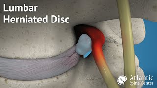 Lumbar Herniated Disc Overview [upl. by Ddej640]