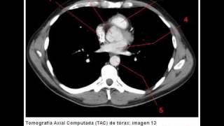 Tomografía Axial Computada TAC de tórax ventana mediastinal [upl. by Yblok]