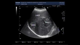 Ultrasound Video showing Hydatid Hepatic Cyst Cholelithiasis and Hepatic masses [upl. by Ama]