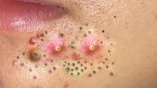 Blackhead Removal With Sac Dep Spa [upl. by Nosloc]