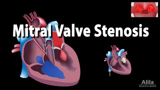 Mitral Valve Stenosis Animation [upl. by Llyrad]