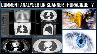 Comment analyser un scanner thoracique [upl. by Llert660]