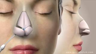 Rhinoplasty Nose Job Video Animation  Guncel Ozturk MD  DRGO [upl. by Nahtannhoj123]