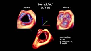 3D Echocardiography Acquisition Cropping and Case Examples [upl. by Ocnarf]