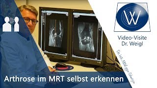 Knieschmerzen Knieverletzung amp Kniearthrose im MRT  Diagnose Arthrose Kreuzbandriss Meniskus [upl. by Pincince]