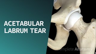 Acetabular Labrum Tear  Pathologies [upl. by Ricker]