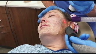 Full Face Fractional CO2 Laser Resurfacing for Wrinkles and Skin Tightening [upl. by Lexie]