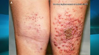 What You Need to Know if You Have Eczema [upl. by Adnaw]