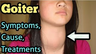 Goiter Symptoms Causes Treatment [upl. by Hilliary]