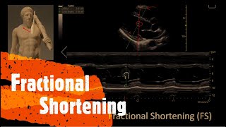 Fractional Shortening Perioperative amp Critical Care ECHO  POCUS [upl. by Newfeld]