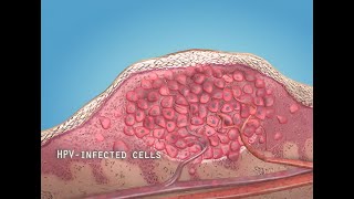 What are warts HPV  3D animation [upl. by Kreegar]