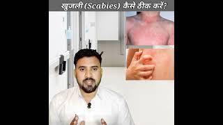 दाद ख़ाज खुज़ली 🦠😳😲Scabies को जड़ से ख़त्म कैसे करे Scabies Treatment in HindiMZhealth [upl. by Wolford872]