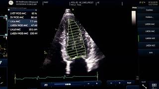 Ejection fraction measurement [upl. by Akemat]