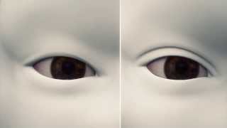 How double eyelid surgery works [upl. by Ylliw]