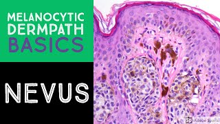 Melanocytic Dermpath Basics Benign Nevus [upl. by Ayam]