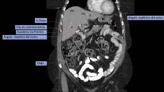 TOMOGRAFIA CORONAL BASICA DE ABDOMEN Y PELVIS [upl. by Yhtnomit537]