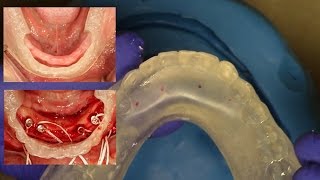 Easy Clinical amp Laboratory Technique for Fabricating an quotInHouse Surgical Guidequot for Overdentures [upl. by Rolan480]