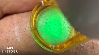 Laser Zaps Out Ingrown Hairs  Art Insider [upl. by Ytinirt536]