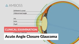 Acute Angle Closure Glaucoma [upl. by Kristi806]