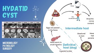 Hydatid cyst [upl. by Leyameg]