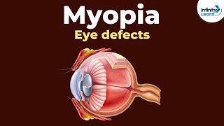 Eye defects  Myopia  Dont Memorise [upl. by Collum]