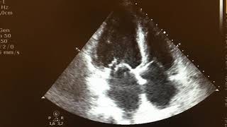 Anterior mitral valve leaflet chordae rupture with severe mitral regurgitation [upl. by Colin]