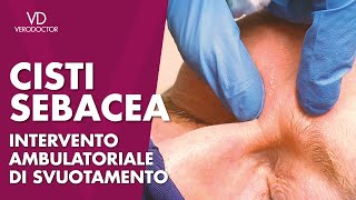 CISTI SEBACEA intervento ambulatoriale di svuotamento [upl. by Gylys]