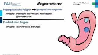 Pathologie ─ Magentumoren [upl. by Coke107]