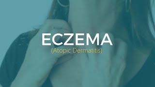 What to do if you have eczema atopic dermatitis [upl. by Dugan]